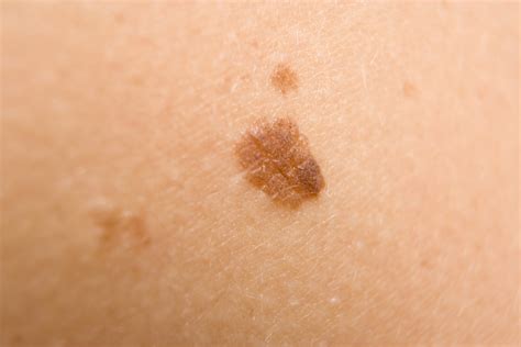 dark spots on skin